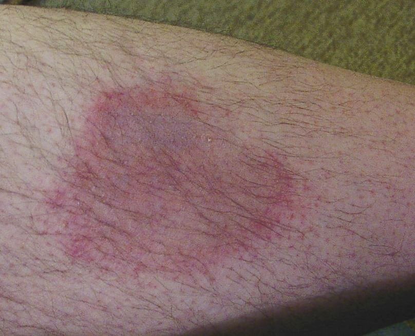 Wanderröte als Folge eines Zeckenstichs mit Borrelioseinfektion, Foto: © Jost Jahn, Wikimedia, CC BY-SA 2.0 de