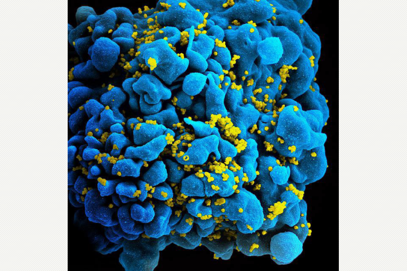Mit HI-Viren (gelb) infizierte T-Zelle (blau) des Immunsystems.