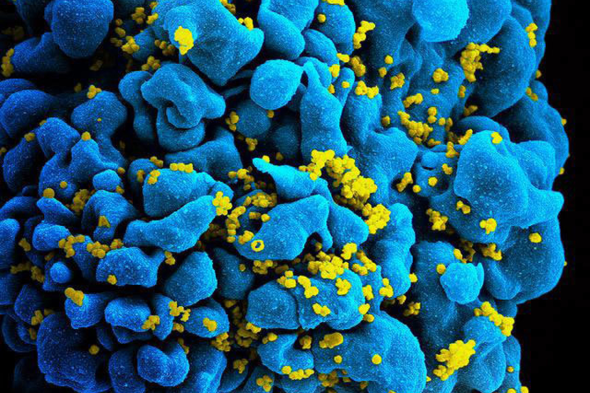 Mit HI-Viren (gelb) infizierte T-Zelle (blau) des Immunsystems.